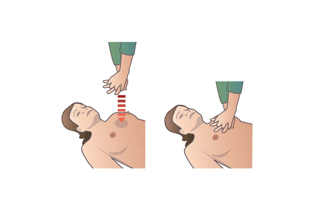 Finns det risker med att göra bröstkompressioner vid HLR