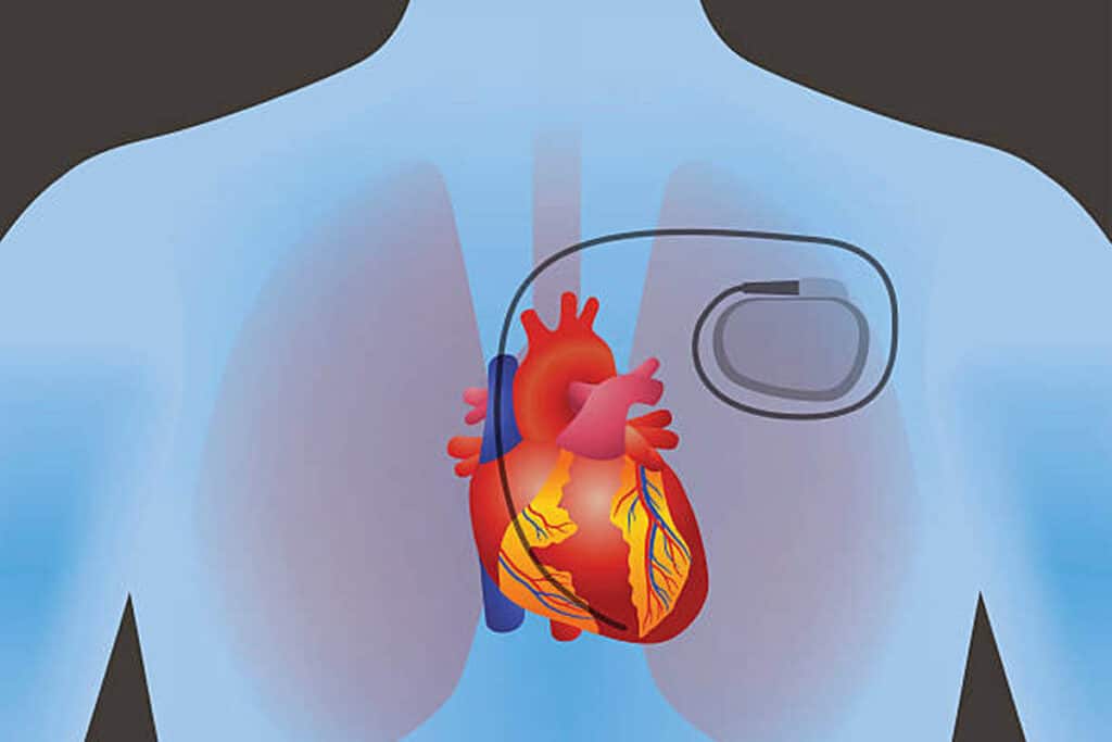 Hur gör du HLR på en person med pacemaker eller ICD (implanterbar defibrillator)?
