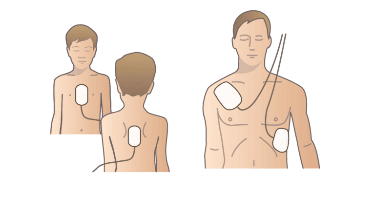Så fäster du elektroderna från en hjärtstartare på barn och vuxen